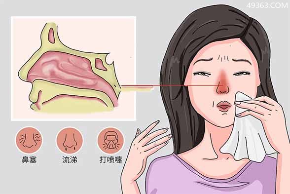 怎样才能迅速缓解鼻炎