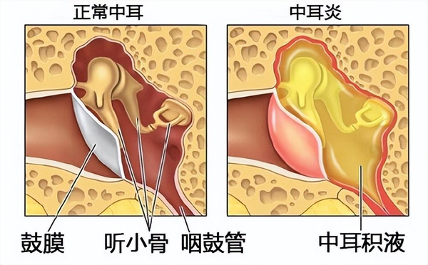 耳膜穿孔能自己恢复吗(耳膜穿孔的危害)