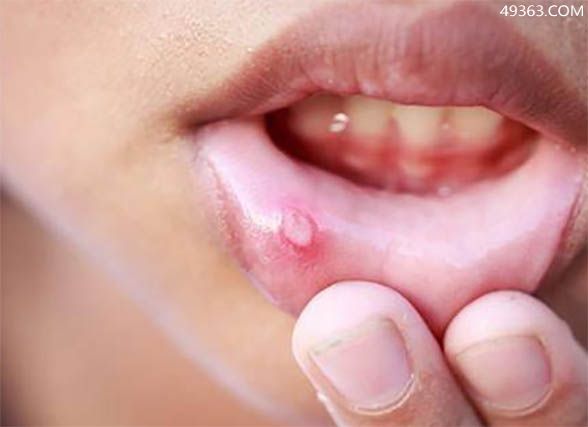 口腔溃疡是怎么引起的原因