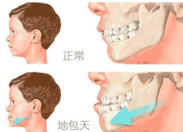 地包天的形成原因