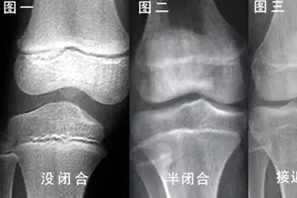 骨骺线闭合说明停止长高了