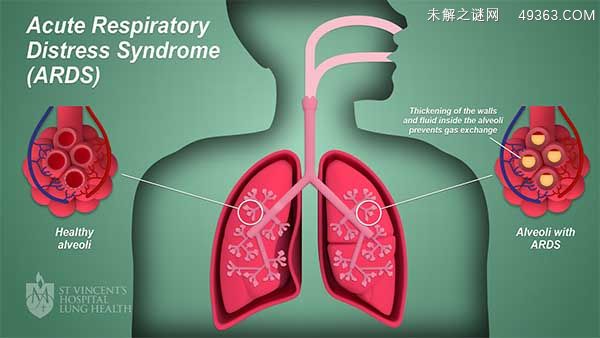 ARDS是一个危重的疾病