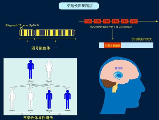 亨廷顿舞蹈症